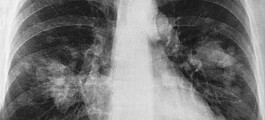 Håp om lengre levetid for lungekreftpasienter