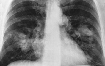 Lungekreft. De hvite skyggene som beveger seg utover fra ryggraden er kreftsvulster. (Foto: National Cancer Institute) Lungekreft. De hvite skyggene som beveger seg utover fra ryggraden er kreftsvulster. (Foto: National Cancer Institute)