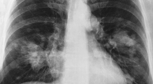 Håp om lengre levetid for lungekreftpasienter