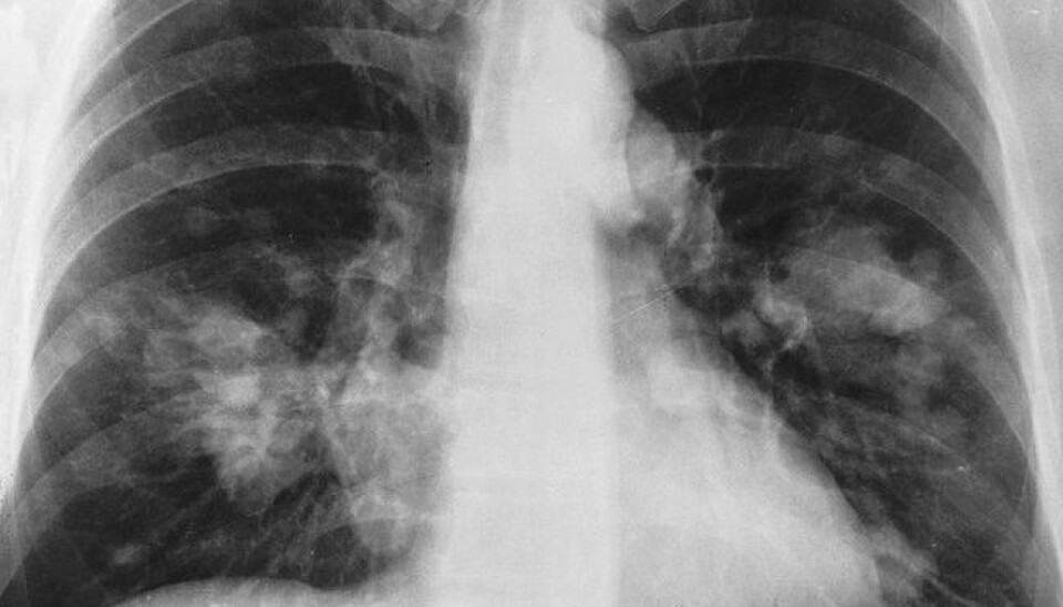 Lungekreft. De hvite skyggene som beveger seg utover fra ryggraden er kreftsvulster. National Cancer Institute