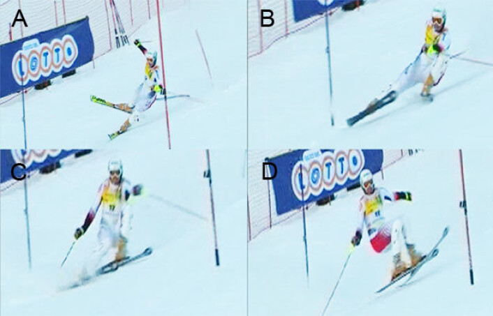 "Slip-catch"-situasjon: A: utøveren er i ubalanse bakover og innover i en venstresving. B: strekker ut beinet for å prøve og gjenvinne grep på ytterskien. C: innerkanten på ytterskien griper brått tak i snøen (antatt skadetidspunkt). D: utøveren faller bakover og over til høyre. (Foto: (Foto/illustrasjon: Senter for idrettsskadeforskning)) "Slip-catch"-situasjon: A: utøveren er i ubalanse bakover og innover i en venstresving. B: strekker ut beinet for å prøve og gjenvinne grep på ytterskien. C: innerkanten på ytterskien griper brått tak i snøen (antatt skadetidspunkt). D: utøveren faller bakover og over til høyre. (Foto: (Foto/illustrasjon: Senter for idrettsskadeforskning))