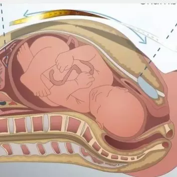 Den gravide måler avstanden mellom toppen av livmoren og øverst på skambeinet. (Foto: NTNU)