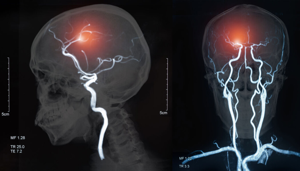 Bildet viser en MRI av blodårer i hjernen og hjerneslag som skyldes hjerneblødning eller blodpropp. Bildet viser en MRI av blodårer i hjernen og hjerneslag som skyldes hjerneblødning eller blodpropp.