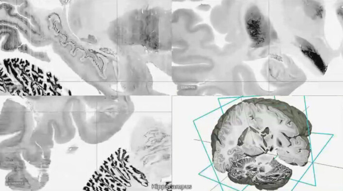 Snitt gjennom 3D-hjernen BigBrain viser detaljer i området hippocampus. (Foto: (Bilde: Fra video av Montreal Neurological Institute/McGill University, Institute of Neuroscience and Medicine/Research Centre Juelich, and National Research Council of Canada.)) Snitt gjennom 3D-hjernen BigBrain viser detaljer i området hippocampus. (Foto: (Bilde: Fra video av Montreal Neurological Institute/McGill University, Institute of Neuroscience and Medicine/Research Centre Juelich, and National Research Council of Canada.))