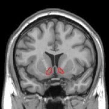 Et MRI-bilde viser hvor i hjernen Nucleus accumbens, et senter viktig for velvære, sitter. (Foto: Wikimedia commons) Et MRI-bilde viser hvor i hjernen Nucleus accumbens, et senter viktig for velvære, sitter. (Foto: Wikimedia commons)
