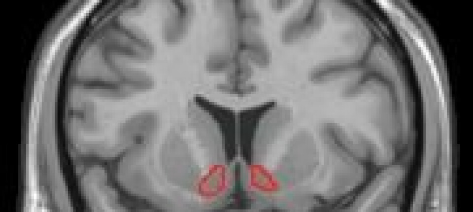 Et MRI-bilde viser hvor i hjernen Nucleus accumbens, et senter viktig for velvære, sitter. Wikimedia commons