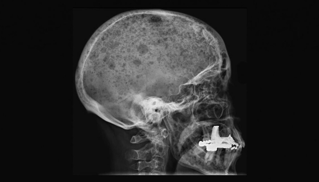 Mange mennesker med beinmargskreft ender ofte opp med hullete skjelett. Dette er svært smertefullt å leve med. På dette fotoet vises hull i kraniet. Mange mennesker med beinmargskreft ender ofte opp med hullete skjelett. Dette er svært smertefullt å leve med. På dette fotoet vises hull i kraniet.