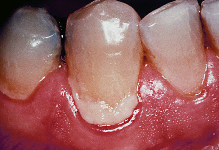 Plysj på tenna? Det er bakterier i biofilm du kjenner med tungespissen. (Foto: Anne Aamdal Scheie) Plysj på tenna? Det er bakterier i biofilm du kjenner med tungespissen. (Foto: Anne Aamdal Scheie)