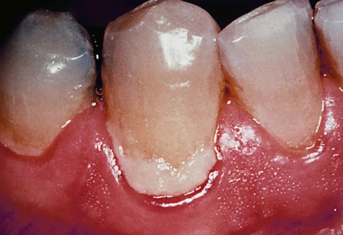 Plysj på tenna? Det er bakterier i biofilm du kjenner med tungespissen. (Foto: Anne Aamdal Scheie)