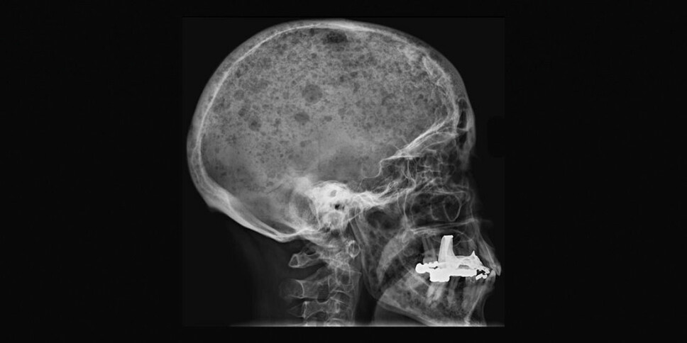 Many people with bone marrow cancer often end up with perforations in their bone tissue. This is very painful to live with. The photo shows these kinds of perforations in the skull.