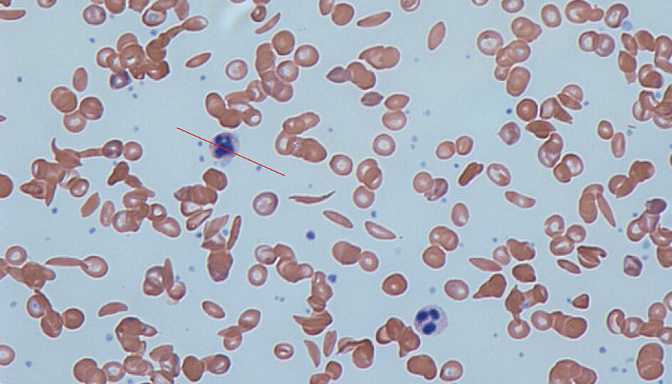 Vanlige blodceller og celler formet som en sigd.