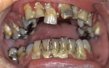 Et velfungerende tannsett kan få store skader bare i løpet av få måneder. Her ses resultater av manglende renhold hos eldre syk person. (Foto: (Illustrasjonsfoto med tillatelse fra G. Strand, UiB))