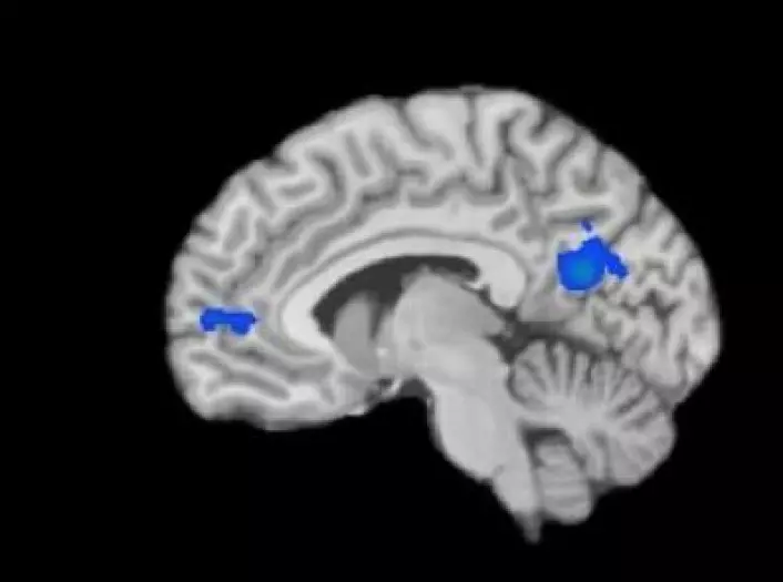Den blå fargen markerer områdene i de mediterendes hjerner som hadde en redusert aktivitet. (Foto: Courtesy of Yale)