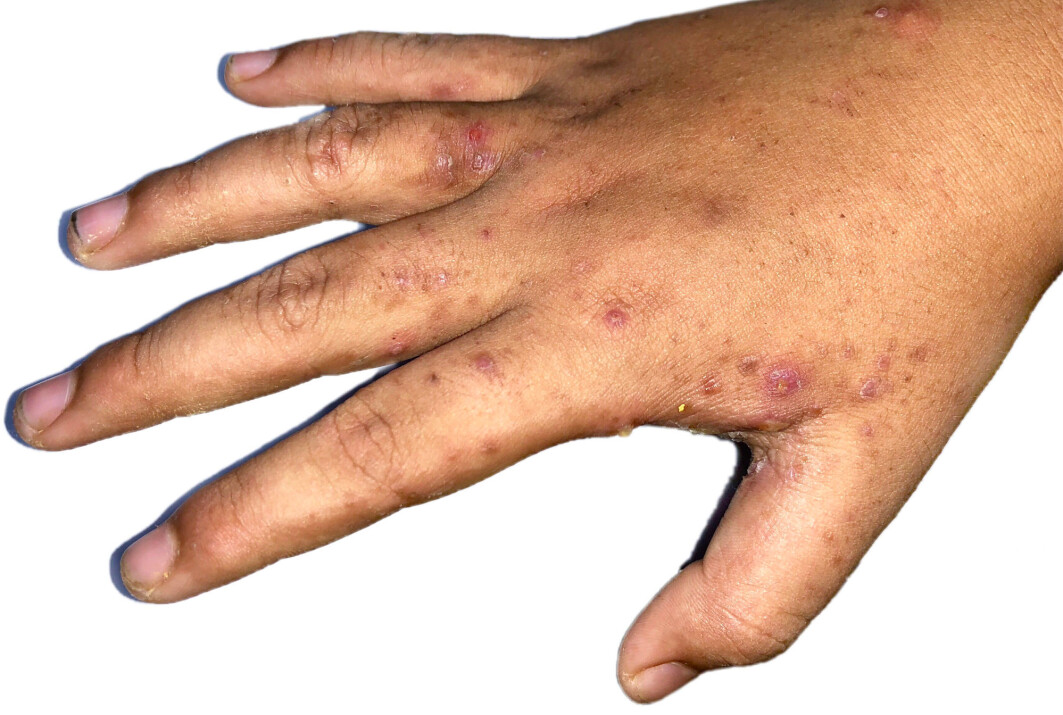 Skabb gjør at vi klør og får utslett blant annet mellom fingrene, rundt håndledd og bak knær. Skabb gjør at vi klør og får utslett blant annet mellom fingrene, rundt håndledd og bak knær.