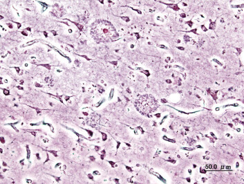 "Hjernebarken til en Alzheimers pasient inneholder ansamlinger av plakk. Sykdommen kan ikke fastslås definitivt før pasienten er død og hjernen er obdusert." "Hjernebarken til en Alzheimers pasient inneholder ansamlinger av plakk. Sykdommen kan ikke fastslås definitivt før pasienten er død og hjernen er obdusert."