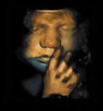 Stillbilde fra forskernes ultralyd som viser et 33 uker gammelt foster i en noe tenksom positur. (Foto: Nadja Reissland, m.fl, 2011) Stillbilde fra forskernes ultralyd som viser et 33 uker gammelt foster i en noe tenksom positur. (Foto: Nadja Reissland, m.fl, 2011)