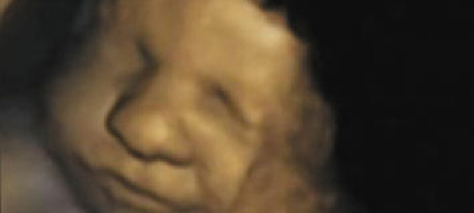 Stillbilde fra 4D-ultralyd av 32 uker gammelt foster, som ifølge forskerne viser typiske ansiktstrekk for latter. I dette frossede øyeblikket ser vi et lite lurt smil. Nadja Reissland, m.fl, 2011