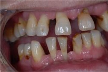 Mer enn halvparten av alle nordmenn vil bli rammet av periodontitt. (Foto: Hans R. Preus) Mer enn halvparten av alle nordmenn vil bli rammet av periodontitt. (Foto: Hans R. Preus)