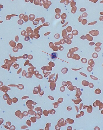 Om du får genet for sigdformede blodceller fra bare én forelder, beskytter det mot malaria. Får du genet fra begge foreldrene dine, kan det heller øke risikoen for blodpropp. (Foto: Dr Graham Beards/Wikimedia Common) Om du får genet for sigdformede blodceller fra bare én forelder, beskytter det mot malaria. Får du genet fra begge foreldrene dine, kan det heller øke risikoen for blodpropp. (Foto: Dr Graham Beards/Wikimedia Common)