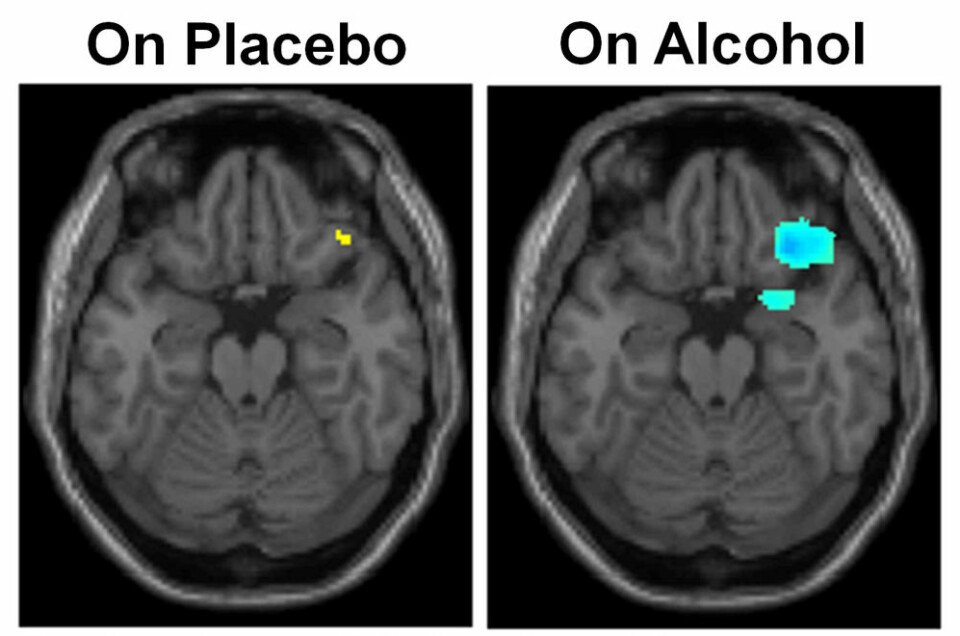 Områder med økt aktivitet er farget gult og deler med redusert aktivitet er blå. Bildene fortalte forskerne at alkohol hemmet kommunikasjonen mellom noen av hjernedelene. (Foto: (Illustrasjon: UIC))