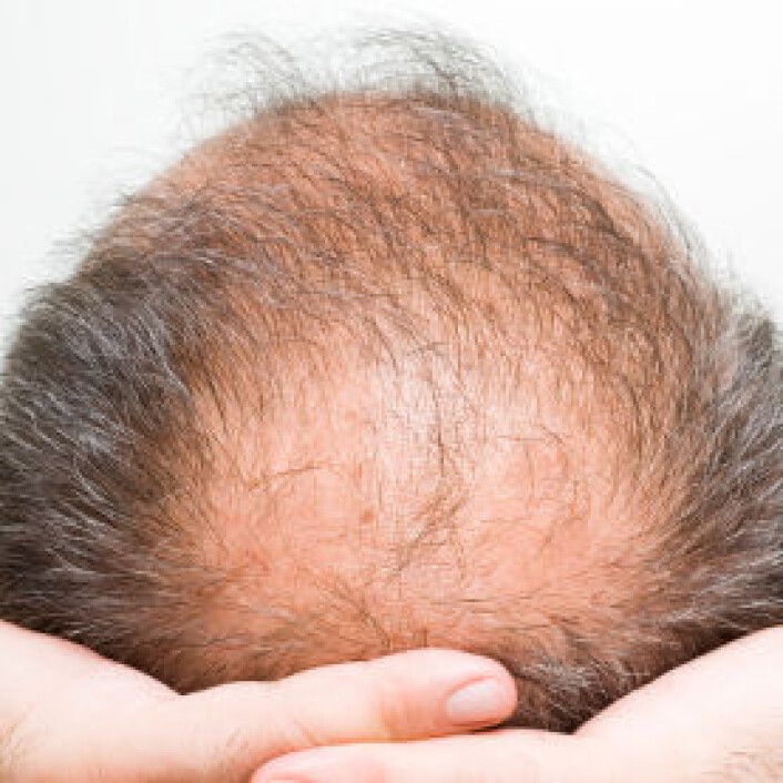Enzymer og testosteron fører til en langsom død for disse hårene. (Illustrasjon: iStockphoto) Enzymer og testosteron fører til en langsom død for disse hårene. (Illustrasjon: iStockphoto)