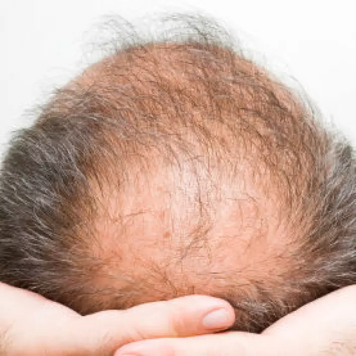 Enzymer og testosteron fører til en langsom død for disse hårene. (Illustrasjon: iStockphoto)