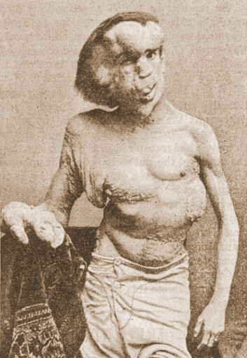 Joseph Merrick, kjent som Elefantmannen, fotografert i 1889, året før han døde. (Foto: Wikimedia Commons, ukj. fotograf) Joseph Merrick, kjent som Elefantmannen, fotografert i 1889, året før han døde. (Foto: Wikimedia Commons, ukj. fotograf)