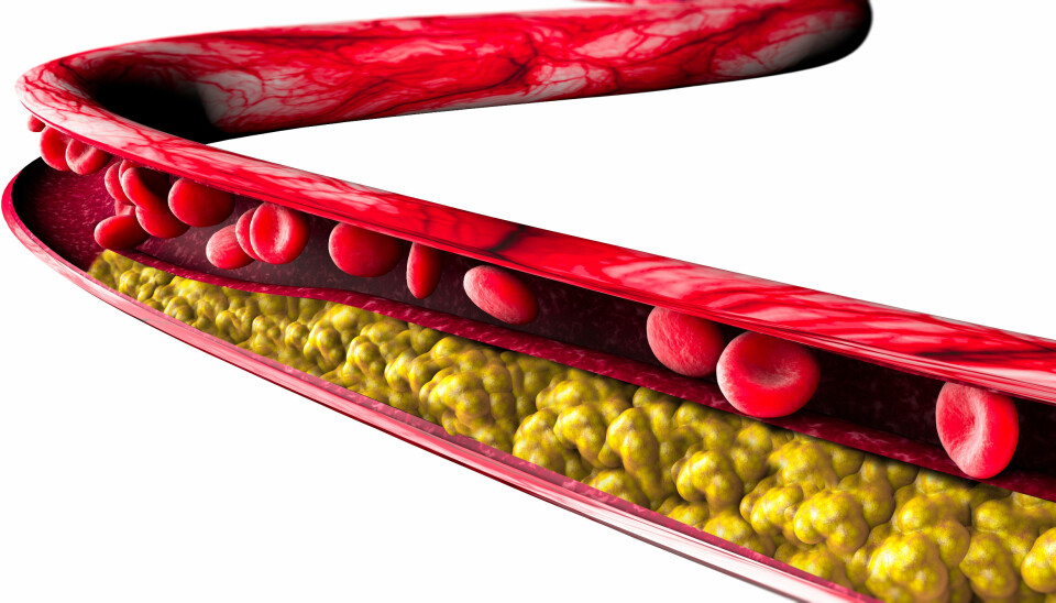 The development of atherosclerosis is dependent on the balance of various types of lipoproteins that carry fat in and out of the body.