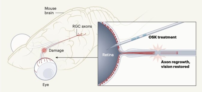 Illustrasjonen viser hvordan behandlingen og gjendannelse av synet hos mus fungerer. Retinale ganglieceller (RGC-er) overfører visuell informasjon fra øyet til hjernen langs nervefibre som kalles aksoner. Skader på nervefibrene forhindrer kommunikasjonen, noe som fører til blindhet. Forskerne viser i studien at behandling av nerveceller med de såkalte transkripsjonsfaktorene som kalles OSK gjendanner cellene til en ungdommelig tilstand. Behandlingen resulterer i at det kan vokse fram nye nervefibre. Illustrasjonen viser hvordan behandlingen og gjendannelse av synet hos mus fungerer. Retinale ganglieceller (RGC-er) overfører visuell informasjon fra øyet til hjernen langs nervefibre som kalles aksoner. Skader på nervefibrene forhindrer kommunikasjonen, noe som fører til blindhet. Forskerne viser i studien at behandling av nerveceller med de såkalte transkripsjonsfaktorene som kalles OSK gjendanner cellene til en ungdommelig tilstand. Behandlingen resulterer i at det kan vokse fram nye nervefibre.