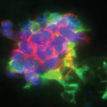 Forskere har oppdaget at visse betennelsesreaksjoner er en del av kroppens naturlige forsvar mot kreft. Bildet viser makrofager, som er typiske betennelsesceller (grønt), som dreper kreftceller (blått og rødt). (Foto: Clara Hammarström)