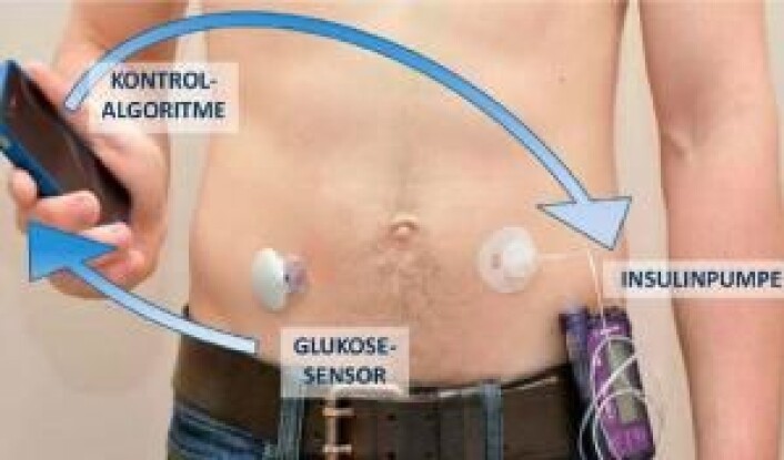 Et "closed loop-system» («lukket kretsløp»), hvor diabetespasienten ideelt sett ikke skal gjøre noe selv for å holde blodsukkeret stabilt. (Foto: (Illustrasjon: Behandlerbladet, Diabetesforeningen)) Et "closed loop-system» («lukket kretsløp»), hvor diabetespasienten ideelt sett ikke skal gjøre noe selv for å holde blodsukkeret stabilt. (Foto: (Illustrasjon: Behandlerbladet, Diabetesforeningen))