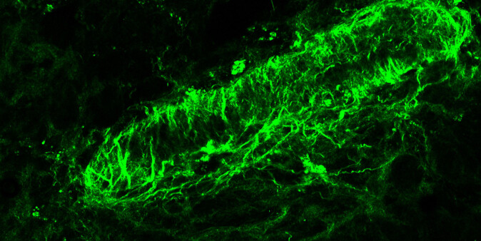 Through advanced microscopes, the researchers were able to detect the cholesterol crystals. Here is a vein from the uterine wall. The green is both cells and a fiber-forming protein. Through advanced microscopes, the researchers were able to detect the cholesterol crystals. Here is a vein from the uterine wall. The green is both cells and a fiber-forming protein.