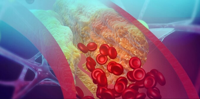 The heart pumps about five litres of blood through the body every minute. The blood vessels that carry blood from the heart become clogged with something called plaque. Cholesterol crystals are found in plaque. The heart pumps about five litres of blood through the body every minute. The blood vessels that carry blood from the heart become clogged with something called plaque. Cholesterol crystals are found in plaque.