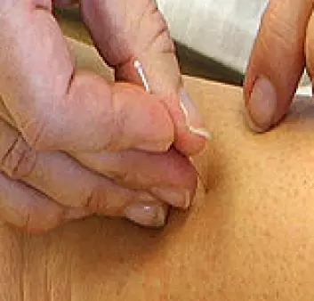 Akupunktur har trolig effekt mot kvalme og oppkast ved cellegiftbehandling.
