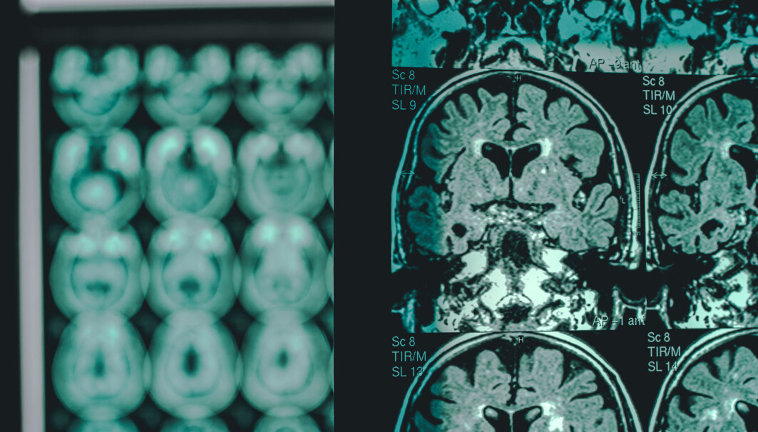 Hittil har man bare kunnet fastslå Alzheimers ved scanning av hjernen eller spinalvæskeprøve. Nå kan en enkel blodprøve-test avsløre sykdommen mange år før den gir merkbare utslag. Hittil har man bare kunnet fastslå Alzheimers ved scanning av hjernen eller spinalvæskeprøve. Nå kan en enkel blodprøve-test avsløre sykdommen mange år før den gir merkbare utslag.