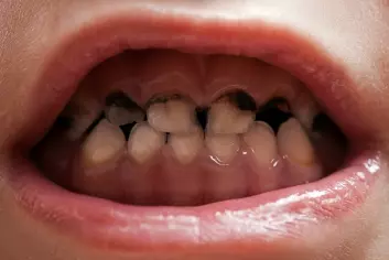 Kan snus hindre at tennene dine blir seende slik ut? Sannsynligvis ikke, konkluderer en svensk doktorgrad. (Foto: Colourbox)