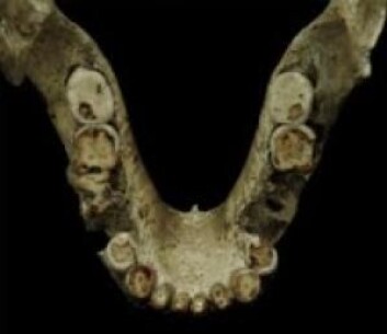Selv om oldtidsmenneskene hadde mistet en tann eller to – eller alle tennerne – kunne de fremdeles overleve. De hadde nemlig redskaper som de kunne lage grøt med. (Foto: Georgian National Museum) Selv om oldtidsmenneskene hadde mistet en tann eller to – eller alle tennerne – kunne de fremdeles overleve. De hadde nemlig redskaper som de kunne lage grøt med. (Foto: Georgian National Museum)