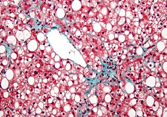 New genes discovered that regulate level of harmful fatty substances in liver