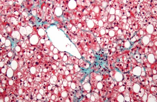 New genes discovered that regulate level of harmful fatty substances in liver