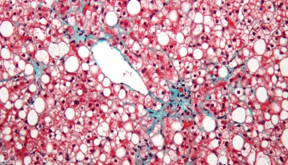 The disease non-alcoholic fatty liver disease, NAFLD, is the most common liver disease in the Western world. Here is a micrograph of a patient's liver with NAFLD.