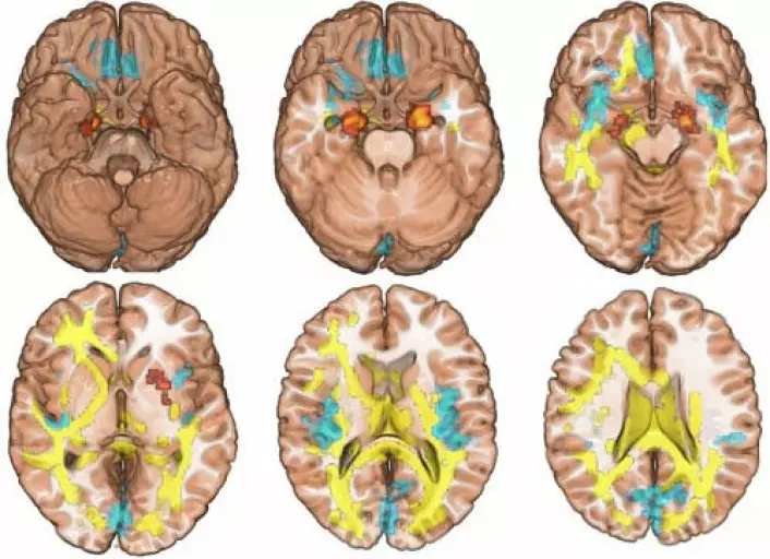 Hjerneskanningar av syskenpar der den eine misbruker narkotika og den andre ikkje. (Foto: (Illustrasjon: Science))