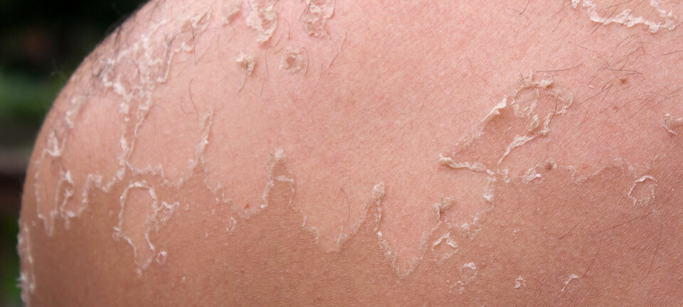 For mye sol kan føre til hudlidelsen aktinisk keratose, som kan være et forstadium til hudkreft. Et dansk firma har utviklet en krem som inneholder stoffet ingenol, og som i løpet av få dager kan fjerne hudlidelsen. Bildet viser en solbrent skulder. Colourbox
