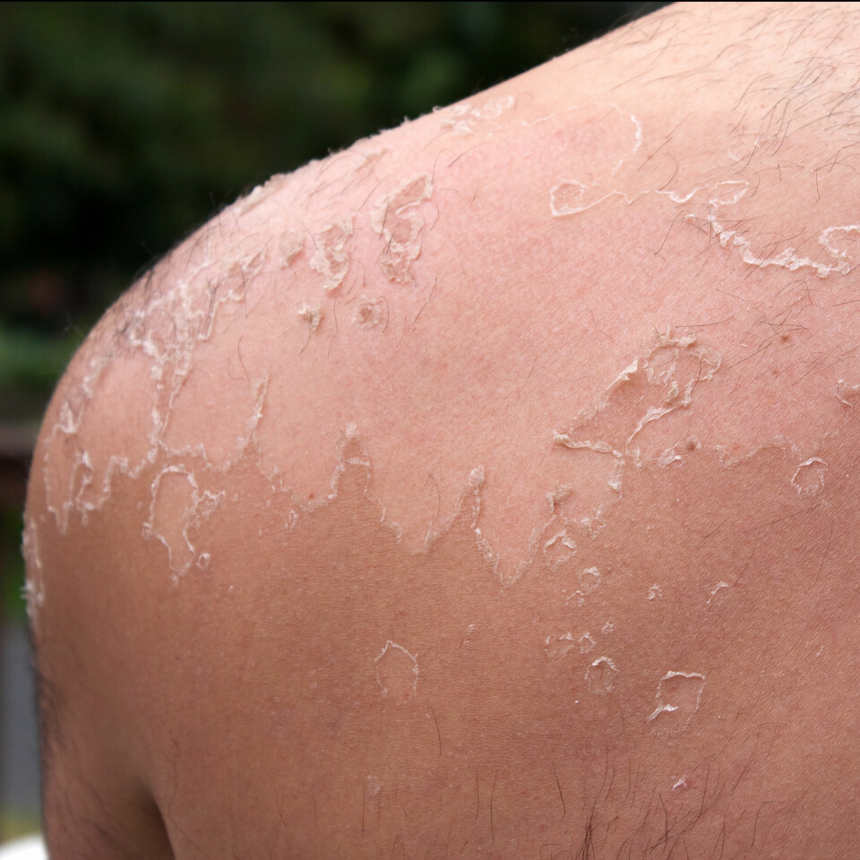 For mye sol kan føre til hudlidelsen aktinisk keratose, som kan være et forstadium til hudkreft. Et dansk firma har utviklet en krem som inneholder stoffet ingenol, og som i løpet av få dager kan fjerne hudlidelsen. Bildet viser en solbrent skulder. (Foto: Colourbox)