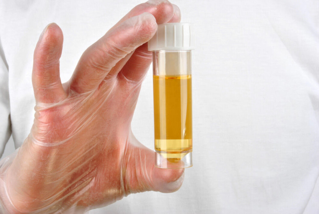 Nedbrytningsstoffer fra hemoglobin farger urin gult. Av forskjellige årsaker kan urinen imidlertid også være brun, rød eller blå. (Foto: Colourbox)