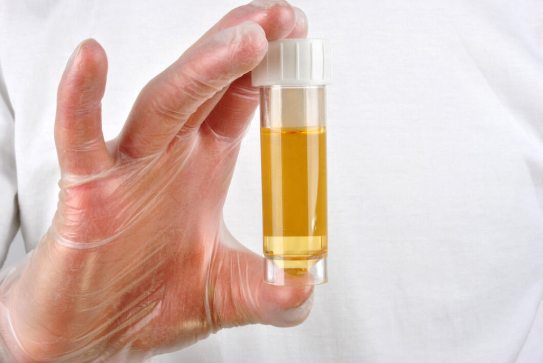 Nedbrytningsstoffer fra hemoglobin farger urin gult. Av forskjellige årsaker kan urinen imidlertid også være brun, rød eller blå. (Foto: Colourbox) Nedbrytningsstoffer fra hemoglobin farger urin gult. Av forskjellige årsaker kan urinen imidlertid også være brun, rød eller blå. (Foto: Colourbox)