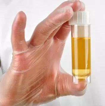 Infeksjon kan fastslås med en urinprøve. (Foto: Colourbox)
