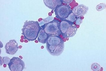 Dette er et mikroskopbilde fra en mus som ikke har immunceller. Her er kun en sammenklumping av kreftceller og røde blodlegemer. (Foto: København Universitet) Dette er et mikroskopbilde fra en mus som ikke har immunceller. Her er kun en sammenklumping av kreftceller og røde blodlegemer. (Foto: København Universitet)