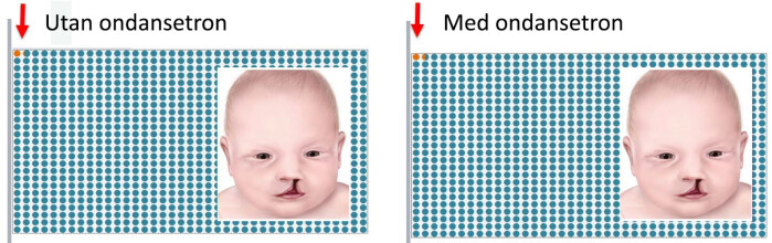 I ein amerikansk studie som omfatta 1,8 millioner graviditetar, fann forskarane ein liten, men signifikant auka risiko for open leppe-gane-spalte hjå kvinner som hadde brukt ondansetron tidleg i svangerskapet. Utan ondansetron var risikoen 11,4 tilfelle per 10 000 kvinner, mot 14 av 10 000 hjå kvinner som hadde brukt ondansetron. I ein amerikansk studie som omfatta 1,8 millioner graviditetar, fann forskarane ein liten, men signifikant auka risiko for open leppe-gane-spalte hjå kvinner som hadde brukt ondansetron tidleg i svangerskapet. Utan ondansetron var risikoen 11,4 tilfelle per 10 000 kvinner, mot 14 av 10 000 hjå kvinner som hadde brukt ondansetron.