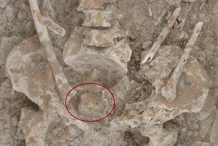 Ser du noe uvanlig? (Foto: Iltirta Arqueologia/International Journal of Paleopathology) Ser du noe uvanlig? (Foto: Iltirta Arqueologia/International Journal of Paleopathology)