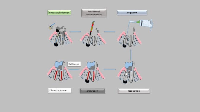Ved rotfylling fjerner tannlegen tannmargen og fyller hulrommet med et bakterietett material for å hindre videre infeksjon. Illustrasjon rotfylling. Ved rotfylling fjerner tannlegen tannmargen og fyller hulrommet med et bakterietett material for å hindre videre infeksjon. Illustrasjon rotfylling.
